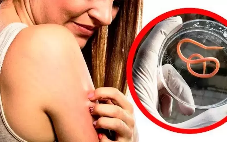 niežulys ir dirginimas dėl parazitų organizme