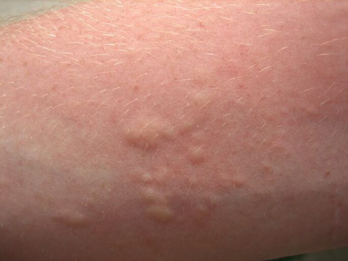 niežtintys alerginiai odos bėrimai gali būti askaridozės simptomai