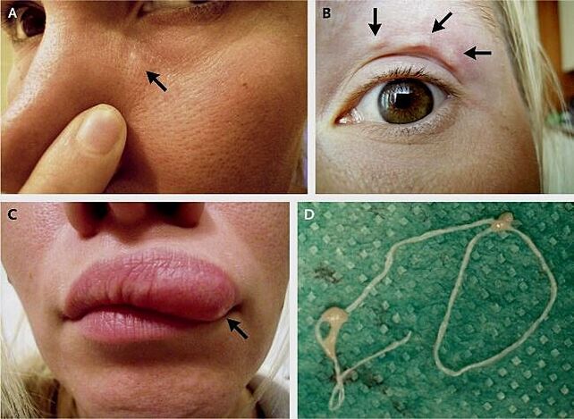 Pagrindinės dirofilariazės apraiškos ant veido